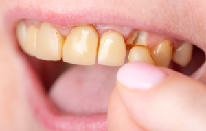 How Dentists Restore Teeth That Are Both Worn And Discolored