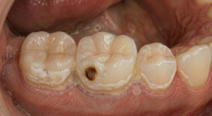 Why Certain Tooth Surfaces Are More Vulnerable To Root Decay