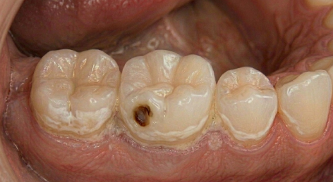 Why Certain Tooth Surfaces Are More Vulnerable To Root Decay